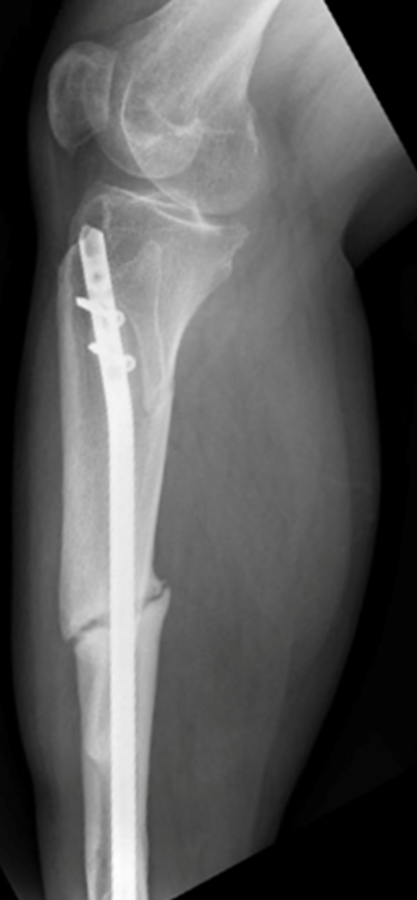 X-ray image of a nonunion fracture