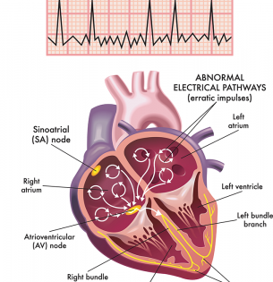 Illustration of atrial fibrillation by rob3000/Adobe Stock