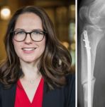 Headshot of Hannah Dailey and x-ray of nonunion bone fracture