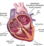 Illustration of atrial fibrillation by rob3000/Adobe Stock