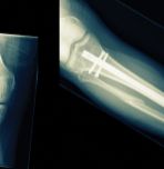 Smoking delays bone healing